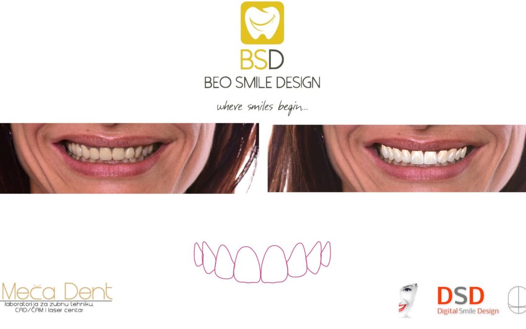 Nova metoda u kreiranju osmeha – DIGITAL SMILE DESIGN