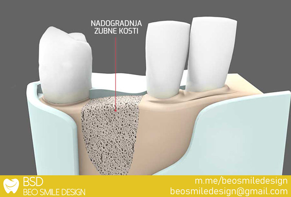 Oralna hirurgija nadogradnja kosti